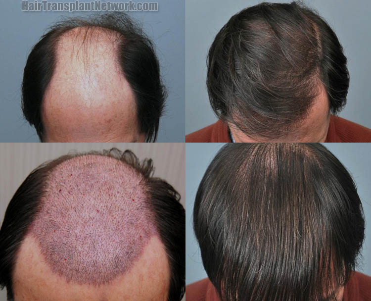 how to regrow hair on bald patch